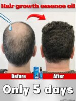 WPRBREGT New blue bottle. Hair growth essential oil. Say goodbye to baldness. The secret of thick hair, hair growth essence